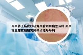 南京蒋王庙皮肤研究所看银屑病怎么样 南京蒋王庙皮肤研究所预约挂号号码