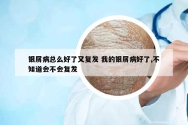 银屑病总么好了又复发 我的银屑病好了,不知道会不会复发