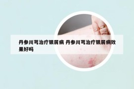 丹参川芎治疗银屑病 丹参川芎治疗银屑病效果好吗
