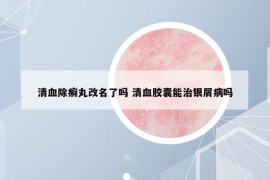 清血除癣丸改名了吗 清血胶囊能治银屑病吗