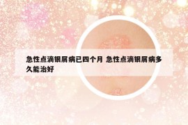 急性点滴银屑病已四个月 急性点滴银屑病多久能治好