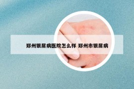 郑州银屑病医院怎么样 郑州市银屑病