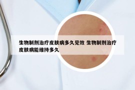生物制剂治疗皮肤病多久见效 生物制剂治疗皮肤病能维持多久