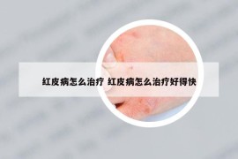 红皮病怎么治疗 红皮病怎么治疗好得快
