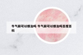 牛气藓可以根治吗 牛气藓可以根治吗百度百科