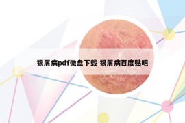银屑病pdf微盘下载 银屑病百度贴吧