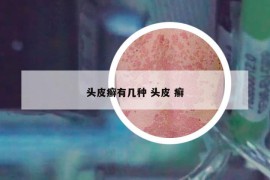 头皮癣有几种 头皮 癣