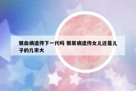 银血病遗传下一代吗 银屑病遗传女儿还是儿子的几率大