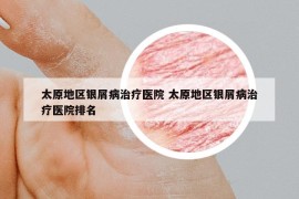 太原地区银屑病治疗医院 太原地区银屑病治疗医院排名