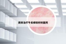 西安治疗牛皮癣较好的医院
