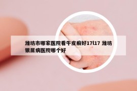 潍坊市哪家医院看牛皮癣好17l17 潍坊银屑病医院哪个好