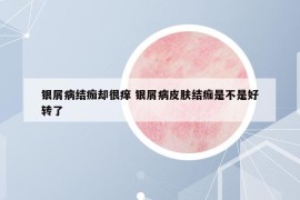 银屑病结痂却很痒 银屑病皮肤结痂是不是好转了