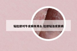 贴肚脐对牛皮癣有用么 肚脐贴治皮肤病