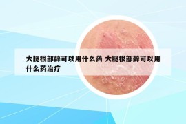 大腿根部藓可以用什么药 大腿根部藓可以用什么药治疗