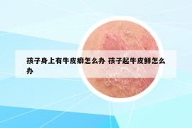 孩子身上有牛皮癖怎么办 孩子起牛皮鲜怎么办