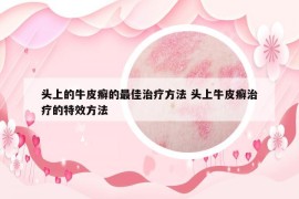 头上的牛皮癣的最佳治疗方法 头上牛皮癣治疗的特效方法