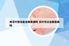 用艾叶擦洗能治银屑病吗 艾叶可以治银屑病吗