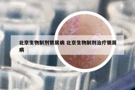 北京生物制剂银屑病 北京生物制剂治疗银屑病