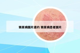 银屑病图片速约 银屑病患者图片