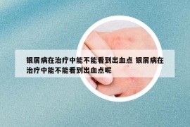 银屑病在治疗中能不能看到出血点 银屑病在治疗中能不能看到出血点呢