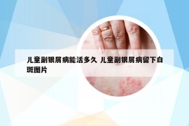 儿童副银屑病能活多久 儿童副银屑病留下白斑图片