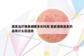 激素治疗银屑病要多长时间 银屑病用激素药品有什么后遗症