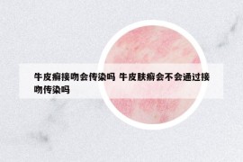 牛皮癣接吻会传染吗 牛皮肤癣会不会通过接吻传染吗