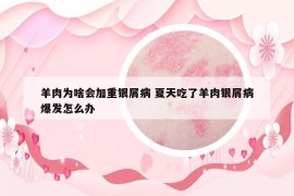 羊肉为啥会加重银屑病 夏天吃了羊肉银屑病爆发怎么办