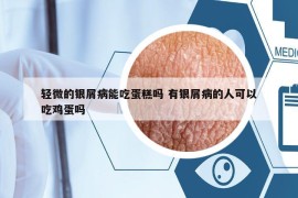 轻微的银屑病能吃蛋糕吗 有银屑病的人可以吃鸡蛋吗