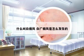 什么叫白癜风 白广癜风是怎么发生的