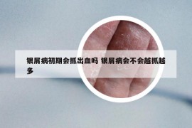 银屑病初期会抓出血吗 银屑病会不会越抓越多