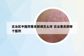 古冶区中医院看皮肤病怎么样 古冶看皮肤哪个医院