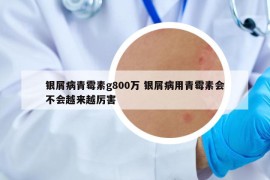 银屑病青霉素g800万 银屑病用青霉素会不会越来越厉害