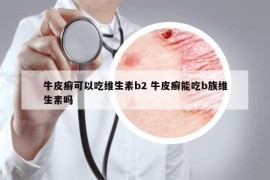 牛皮癣可以吃维生素b2 牛皮癣能吃b族维生素吗