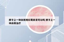脖子上一块白斑用红霉素膏可以吗 脖子上一块白斑治疗