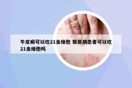 牛皮癣可以吃21金维他 银屑病患者可以吃21金维他吗