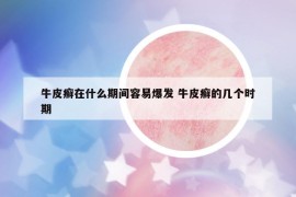 牛皮癣在什么期间容易爆发 牛皮癣的几个时期