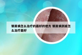 银屑病怎么治疗的最好的地方 银屑病到底怎么治疗最好