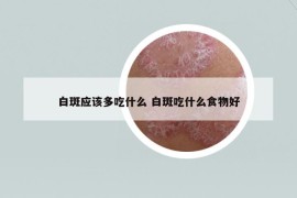 白斑应该多吃什么 白斑吃什么食物好
