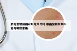 脓疱型银屑病可以吃牛肉吗 脓疱型银屑病不能吃哪些水果