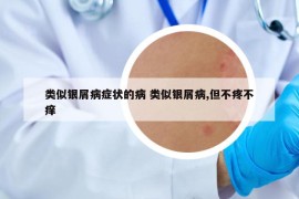 类似银屑病症状的病 类似银屑病,但不疼不痒