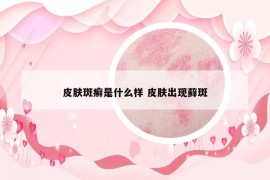 皮肤斑癣是什么样 皮肤出现藓斑
