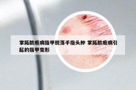 掌跖脓疱病指甲脱落手指头肿 掌跖脓疱病引起的指甲变形