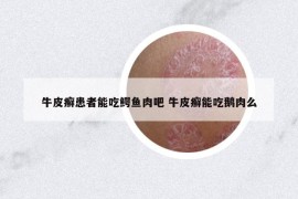 牛皮癣患者能吃鳄鱼肉吧 牛皮癣能吃鹅肉么