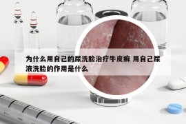 为什么用自己的尿洗脸治疗牛皮癣 用自己尿液洗脸的作用是什么