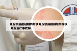 商丘银屑病初期的症状商丘银屑病初期的症状 商丘治疗牛皮癣