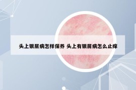 头上银屑病怎样保养 头上有银屑病怎么止痒