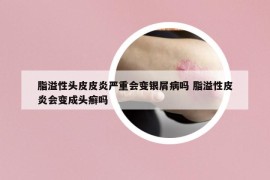 脂溢性头皮皮炎严重会变银屑病吗 脂溢性皮炎会变成头癣吗