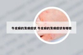 牛皮癣的发病症状 牛皮癣的发病症状有哪些