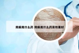 阴癣用什么药 阴癣用什么药膏效果好